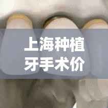 上海种植牙手术价格详解及指导攻略